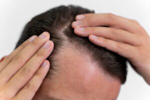 ultimate herbal methods to prevent hair fall